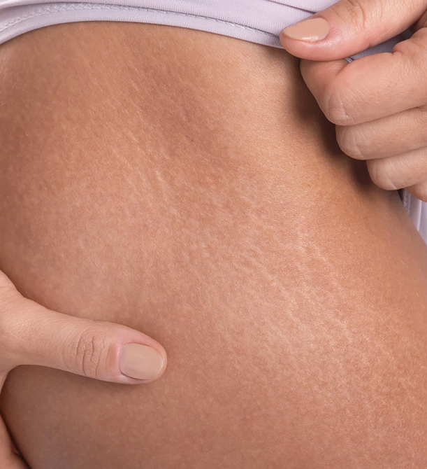 Close up of stretch marks on a womans hip with fingers gently holding the skin